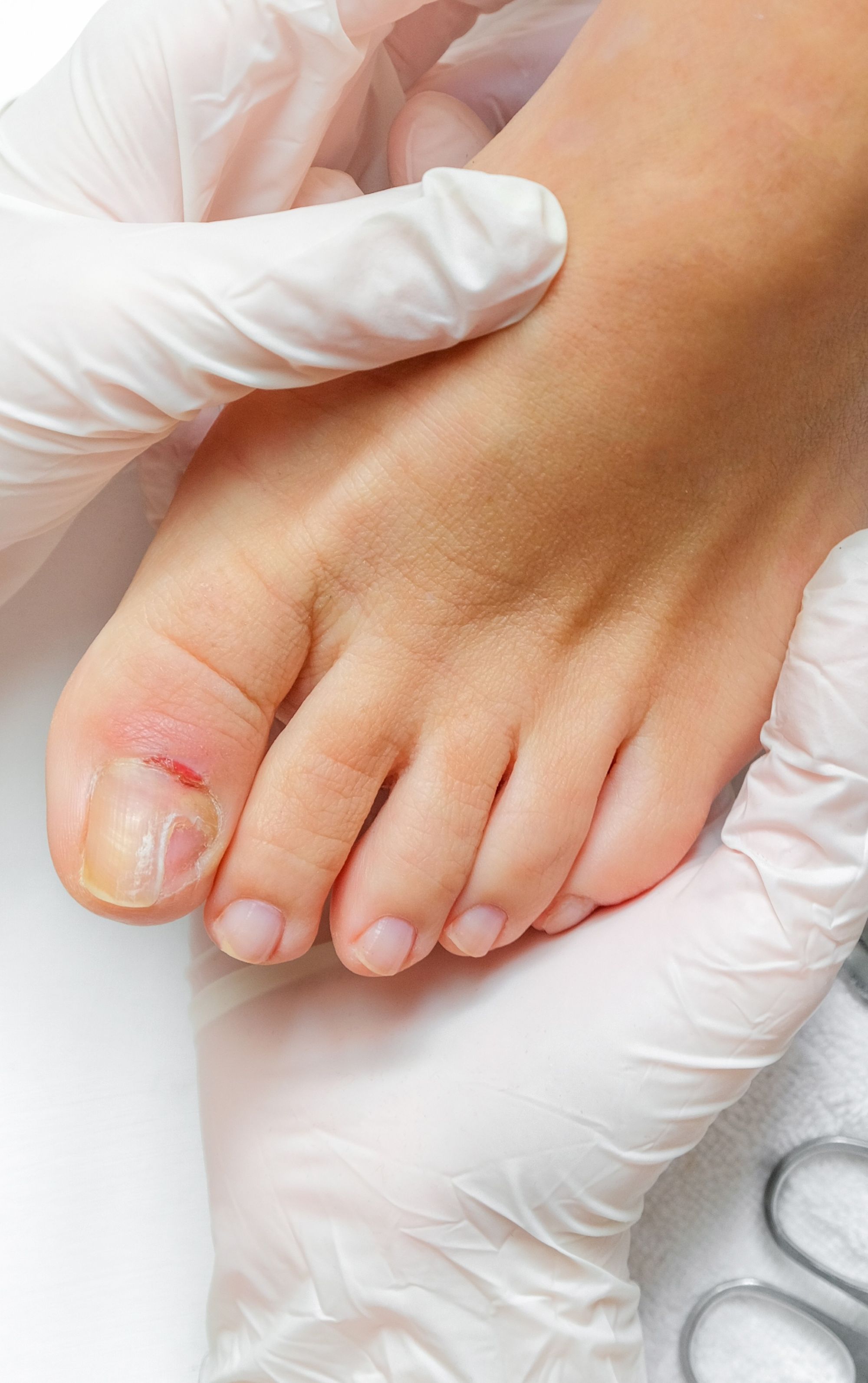 una-encarnada-operacion-houston uñas encarnadas enterradas houston